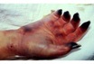 Chilblains